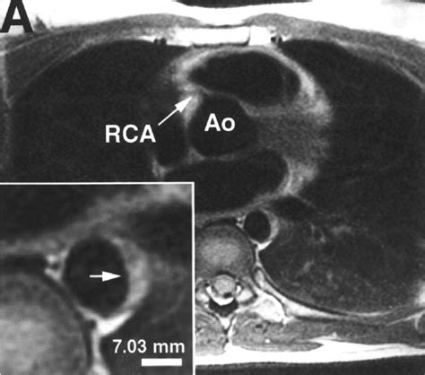 Thoracic aortic atherosclerosis .